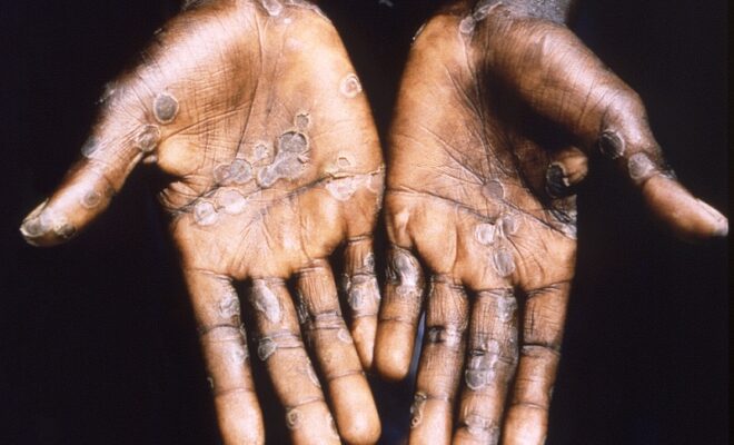 indian warned against monkey pox spreading in europe