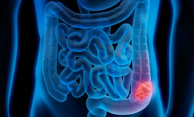 colon cancer