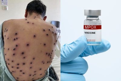 mpox