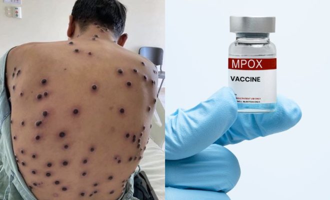 mpox