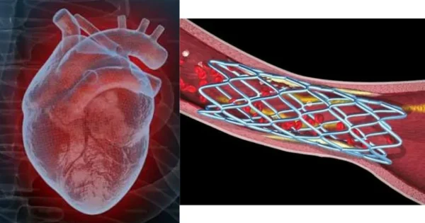 can a heart stent get blocked again expert cardiac surgeon explains post procedure risks