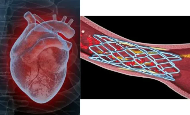 can a heart stent get blocked again expert cardiac surgeon explains post procedure risks